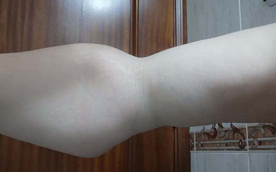 brazo3