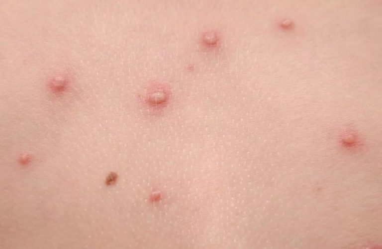 Castilla-La Mancha registra el primer caso de viruela de mono