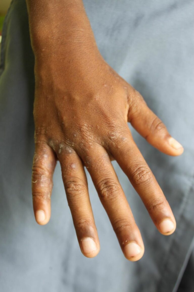 Sanidad admite que los casos de sarna van en aumento en C-LM, pero tranquiliza diciendo que «no ha de generar alarma»