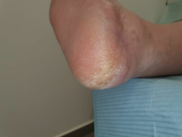 El Colegio Oficial de Podólogos de Castilla-La Mancha ofrece consejos para cuidar los pies en verano