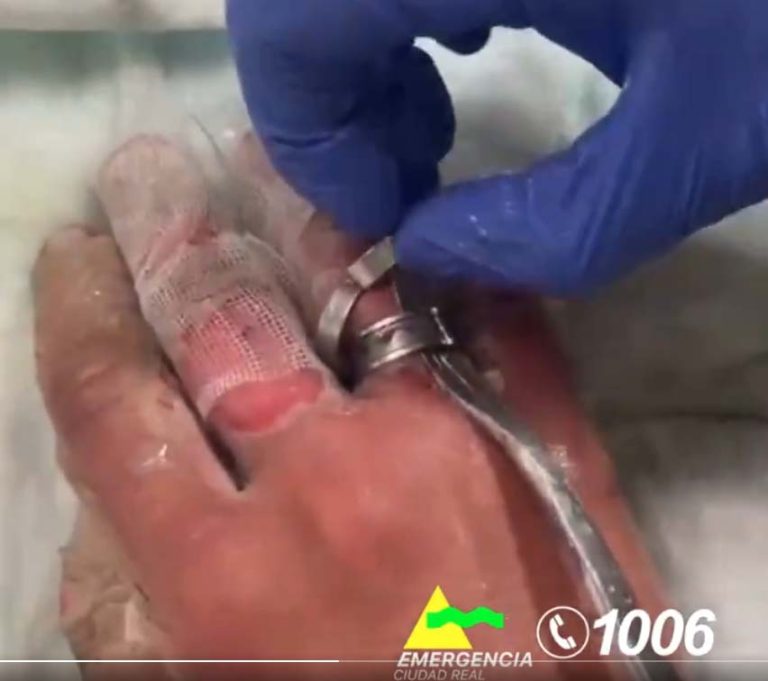 Los bomberos de Ciudad Real extraen un anillo doble de acero a un hombre que acudió a Urgencias con la mano inflamada por quemaduras